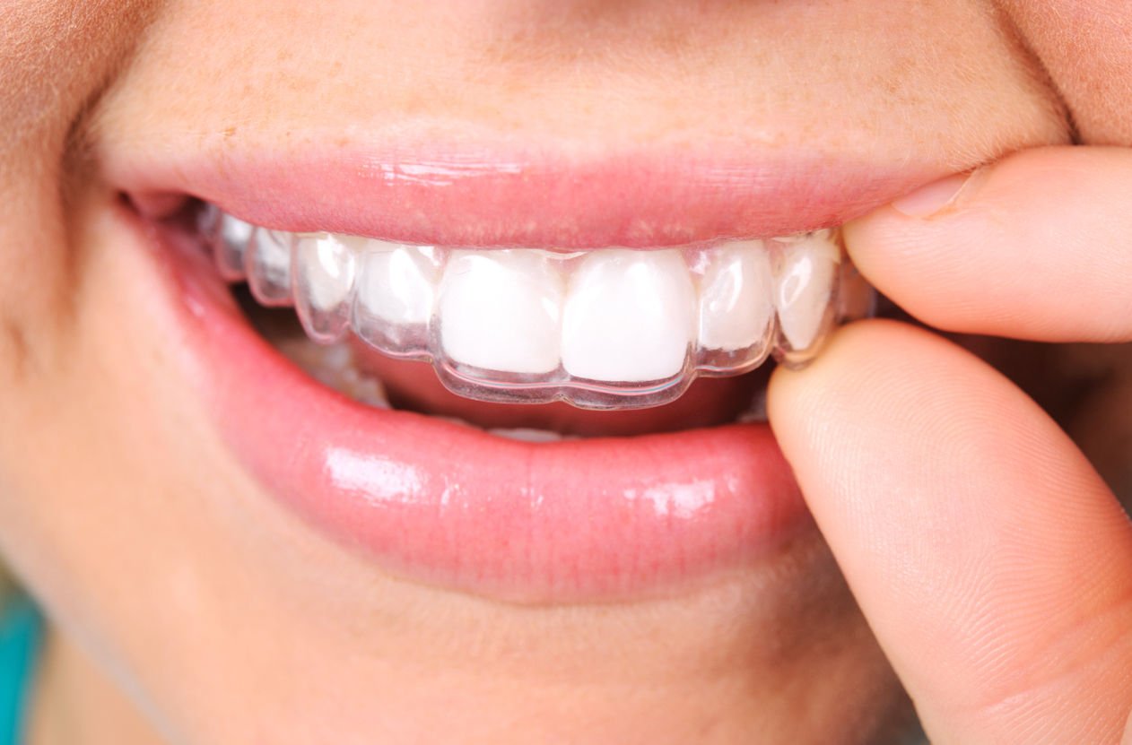 Pekiştirme Plağı (Essix) Nedir?