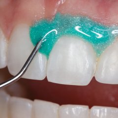 OpalDam Green Kit