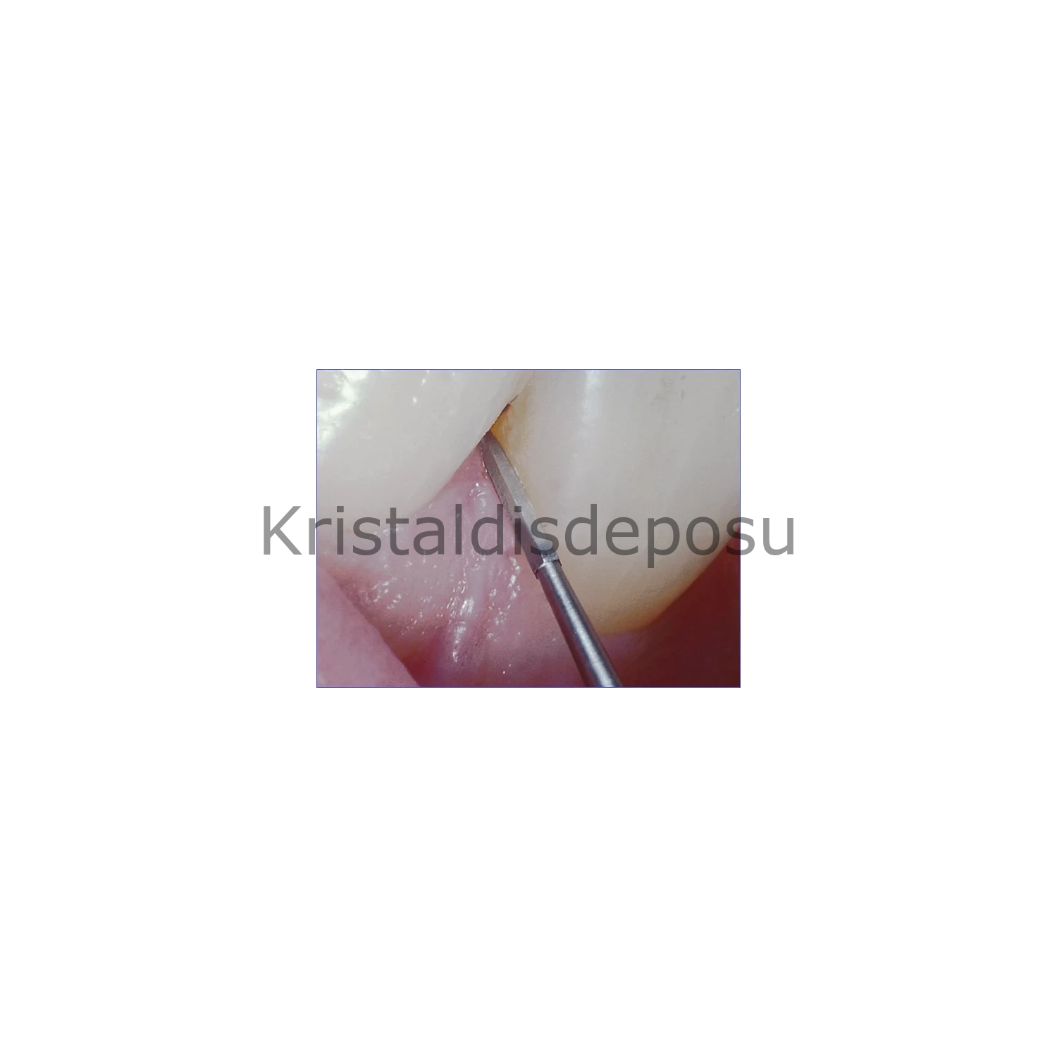 Tungsten Carpide Perio Frezi - 747L - Periodonti Frezi
